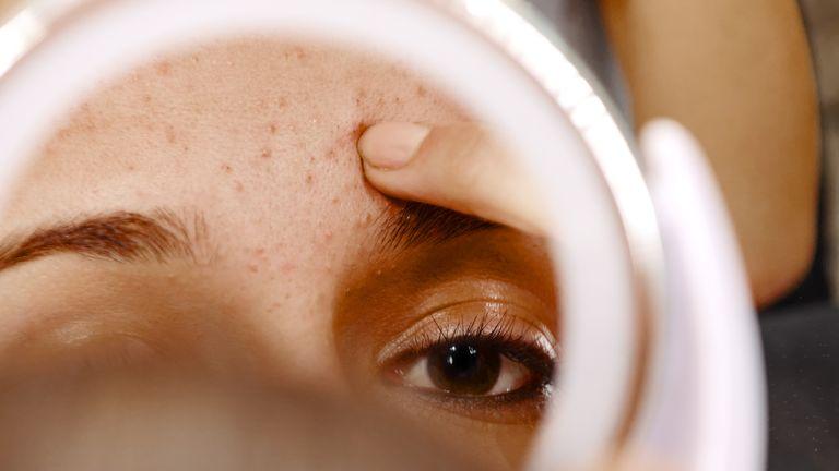 Women with persistent acne offered hope with cheap drug